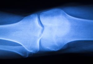 knee xray for regenerative orthopedics book