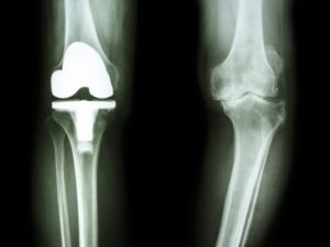 Regenerative Orthopedics and Knee Replacement