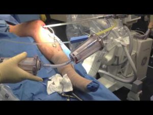 bone grafting and regenerative orthopedics